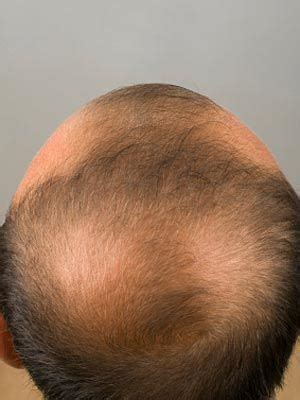 These patches may connect, however, and then become noticeable. 10 Causes of Hair Loss - Hair Loss Center - Everyday Health