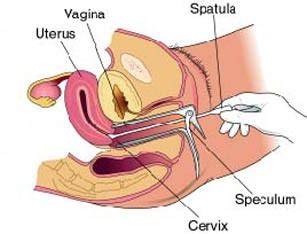 Pemeriksaan pap smear (papanicolaou) adalah sejenis prosedur yang perlu dilakukan dalam tempoh berkala bagi mengesan perubahan pada sel serviks di peringkat awal sebelum ia dapat merebak menjadi sel kanser. winzpink.blogspot.com: Pap Smear tidak menyakitkan!