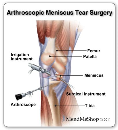 Meniscus surgery is usually completed using an arthroscopic surgical technique, requiring only a few small incisions around the knee joint. Surgical Meniscus Injury Treatments: