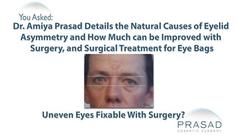 If one side of your eye has droopy eyelids, or if you have uneven eyelids how would that affect your body? Natural Causes of Eyelid Asymmetry and How Upper or Lower ...