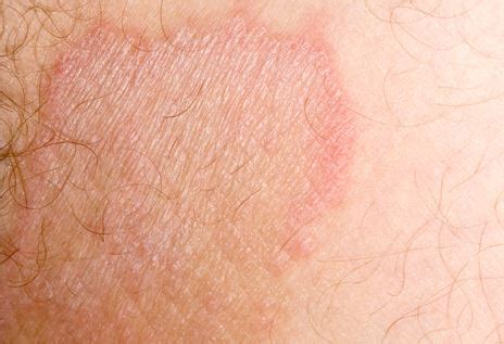 The main cause of this rash is the moist and hot environment of this area. Inner thigh rash- 15 Causes,Symptoms & Treatments
