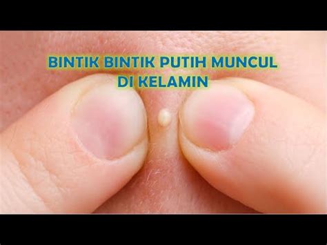 Timbulnya bintik putih ini lebih sering terjadi pada orang yang memiliki kulit putih, orang yang selalu terpapar matahari, dan kemungkinannya semakin meningkat seiring peningkatan usia. BINTIK BINTIK PUTIH MUNCUL DI KELAMIN - YouTube