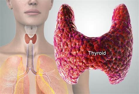 Conditions that can cause hypothyroidism include: Thyroid Problems Explained