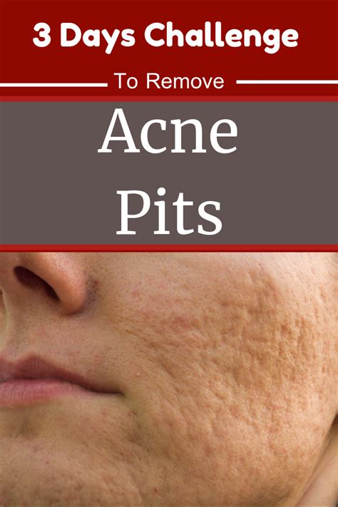 But if you want to remove it quicker, you need to use a cleaning if everything cannot come out at once, just give it time, it will come out just after a few days. Pin on Acne Remedies Hormonal