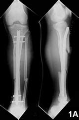 Provisional Unicortical Plating With Reamed Intramedullary ...