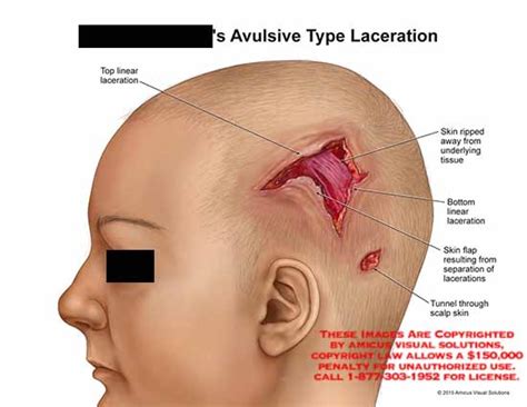 AMICUS Illustration of amicus,injury,scalp,avulsive,type ...