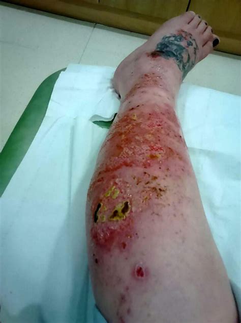 Most spider bites cause mild, treatable symptoms. False widow spider: Mum nearly LOST LEG after bite left ...