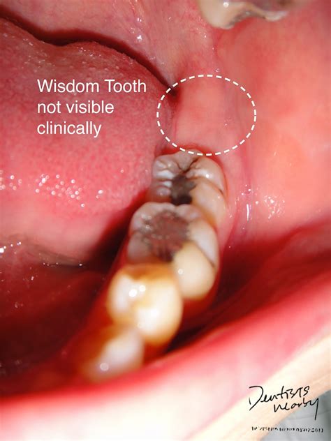 Partial eruption of the wisdom teeth allows an opening for bacteria to enter around the tooth and cause an infection, which results in pain, swelling, jaw stiffness, and general illness. Things to know about Wisdom Tooth Removal - Dr. Siddharth ...