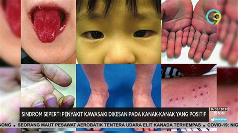 Disebabkan demam kuning nur amanda qaireen. COVID-19 | Penyakit Kawasaki Dikesan Pada Kanak-kanak ...