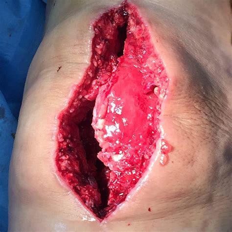 Check spelling or type a new query. (PDF) Wound dehiscence after total knee arthroplasty