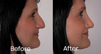 You will have nasal splints and gauze for a week after rhinoplasty surgery with swelling and bruising for up to 2 weeks, which will then start to diminish, but would be slightly visible. Rhinoplasty Nose Surgery Kerala | Nose Job Cost Kochi