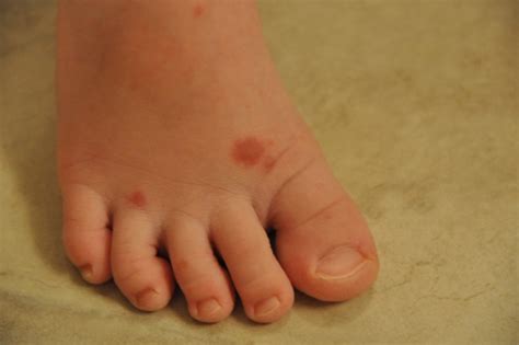 I whole feet is ok it just like because of my camra its no peeling no ithesing just that for years im scrad to death. Organically Green Mommy: My Daughter has Chicken Pox ...