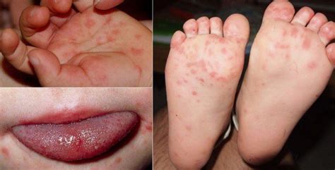 The illness most often occurs in the spring and fall and is most frequently seen in young children, infants, and toddlers. Lam Dong faces hand, foot and mouth disease outbreak ...