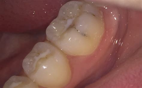 Welche symptome und behandlungen es gibt, lesen sie hier. Ist dieser Zahn mit Karies befallen? (Zähne)