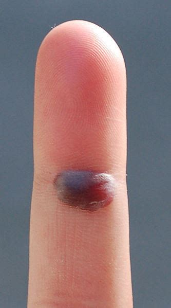 When to see a doctor for a popped blister? Should You Pop a Blood Blister? - The Should