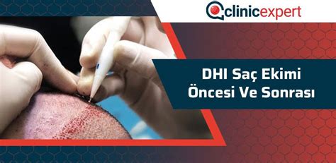 Maybe you would like to learn more about one of these? Dhi Saç Ekimi Öncesi ve Sonrası | ClinicExpert.com