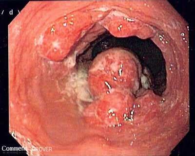 It affects a wider area comprising of larynx. What Does Throat Cancer Look Like