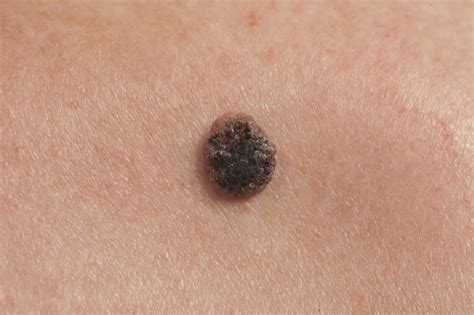 Melanoma is the rarest form of skin cancer, and the only one linked to new or changing moles. Skin Cancer Symptoms That You Shouldn't Ignore ...