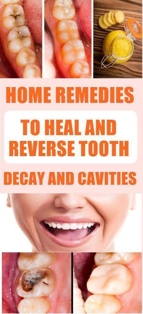 Reduces the ability of bacteria to make acid HOME REMEDIES TO HEAL AND REVERSE TOOTH DECAY AND CAVITIES ...