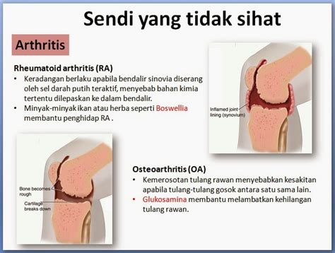 Penyebab sakit pinggang belakang bisa karena gangguan dari otot, tulang belakang, saraf, dll. Health n Beauty Vitamin..: Kenali Gejala dan Simptom ...