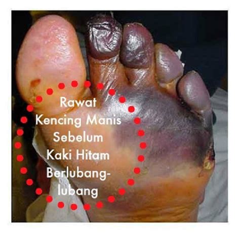 Tibi merupakan sejenis penyakit berjangkit yang boleh membawa maut jika tidak dirawat. Jangan Tunggu Sampai Kaki Dipotong, 5 Tanda-Tanda Kencing ...