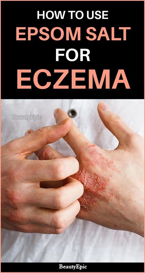 Epsom salt baths have been used for years as a natural remedy to heal skin or infections. how to use epsom salt for eczema #EpsomSaltHealth | Eczema ...