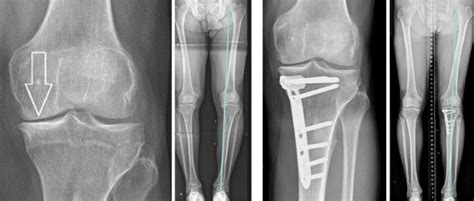 Wie sehen die symptome der coxarthrose aus? Kniearthrose bei Fehlstellungen - Krankheitsbild und ...