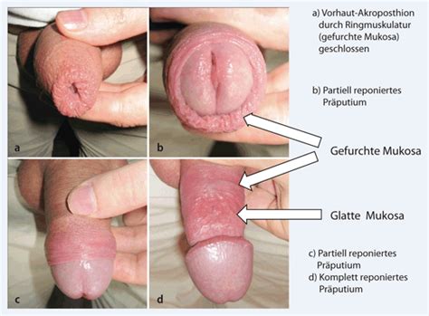 Sind bei geburt noch bei 96% aller jungen die vorhaut und die eichel fest miteinander verbunden. Zirkumzision des Mannes aus infektiologischer Sicht ...