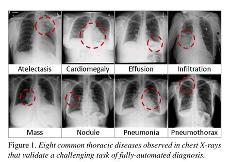 Adenocarcinoma of the lung makes up about 75 percent of all primary lung tumors in dogs. Reza Zadeh on Twitter: "Dataset: 100k chest X-rays from ...
