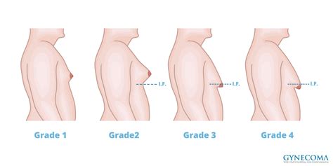 Swollen lymph nodes (sometimes a breast cancer can spread to lymph nodes under the arm or around the collar bone and cause a lump or swelling there, even before the original tumor in. This Guy Developed Breasts & Apparently It's Because He ...