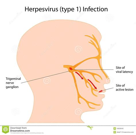 Hantavirus' is a family of viruses that spread by rodents. Herpesvirus Infektion vektor abbildung. Illustration von ...