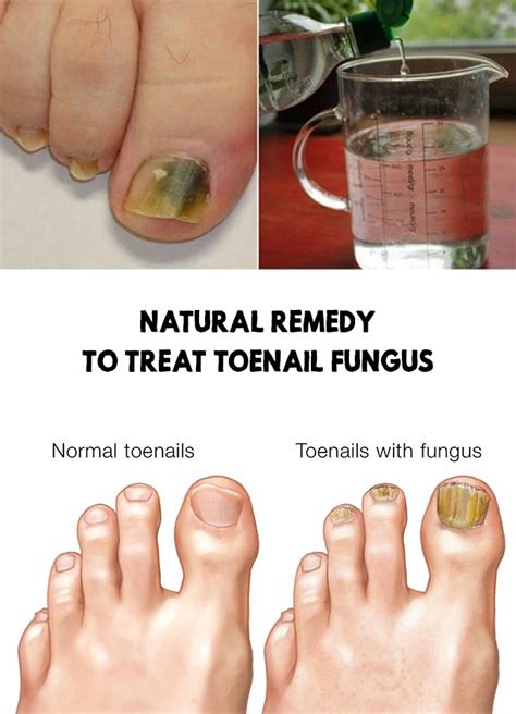 After black fungus, white fungus infection cases reported in india. Natural remedy to treat toenail fungus in 2020 | Toenail ...