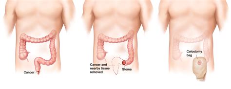 No annoying ads and a better search engine than pornhub! Medical Pictures Info - Anal Cancer