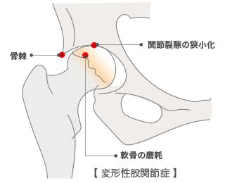 変形性股関節症の症状と予防・治療 | 岐阜市 松岡整形外科 ...