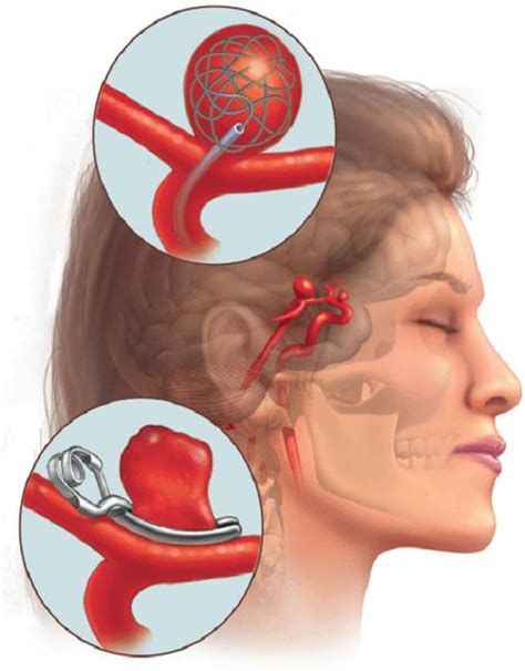 Learn more about this condition in this what is an aneurysm? Aneurysm Symptoms, Causes, Diagnosis and Treatment ...