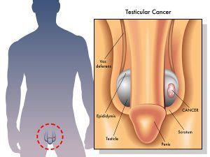 Lump or swelling in the testicle. What does a Testicular Lump look & feel like? Diagnosis ...
