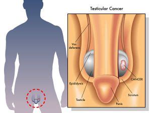 Cancer research uk estimates that fewer than four in every 100 testicular lumps are caused by cancer. What does a Testicular Lump look & feel like? Diagnosis ...