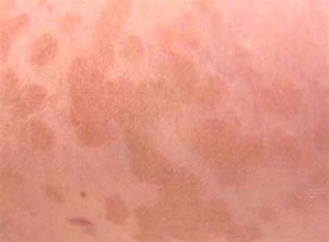 Tinea versicolor or pityriasis alba in neck of southeast asian man. Tinea versicolor : Medical Treasure