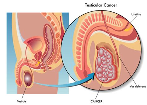 It is not a dangerous condition; Men's Health - University Health News