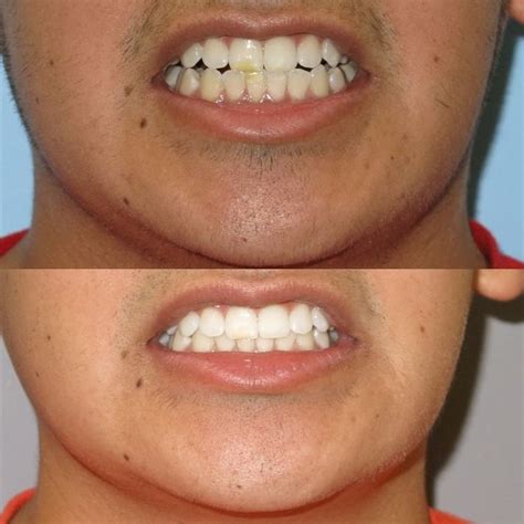 By the time you have your braces taken out; How do I get rid of the brown spots on my teeth ...