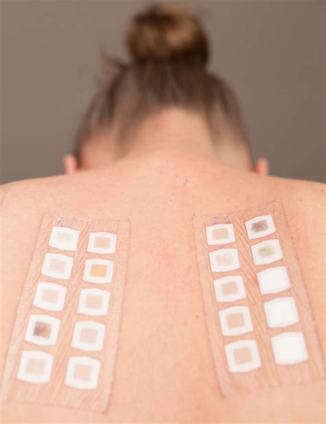 Patch Testing - Skin Alergy Testing - Columbia Skin Clinic