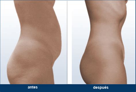 We did not find results for: Liposuccion Vaser Fotos Antes Y Despues | Liptutor.org