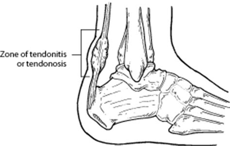 The achilles tendon (tendo calcaneus or tendo achillis) is the thickest and strongest tendon in the human body. What Is Achilles Tendonitis? - Seattle, WA Foot Doctor