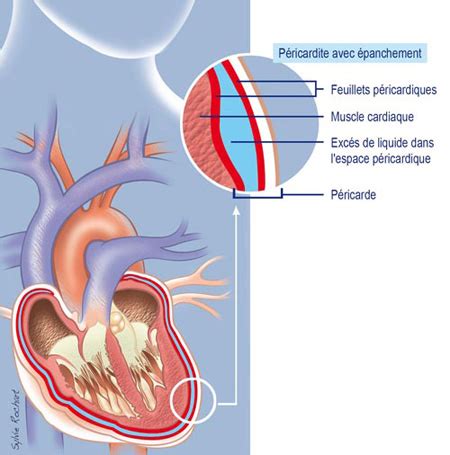Lorsque le cœur se contracte, une partie du péricarde sécrète un liquide (dont la quantité varie entre 30 et 50 ml), qui agit comme un lubrifiant. Pericardite - Sinais, Sintomas e Diagnóstico - As Doenças ...