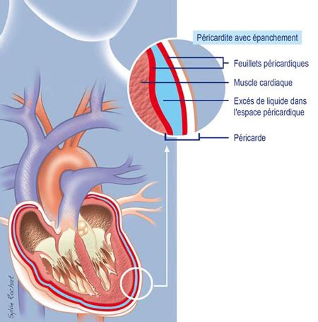 A pericardite purulenta oferece risco de vida imediato e requer confirmação imediata do diagnóstico por pericardiocentese urgente. Pericardite - Sinais, Sintomas e Diagnóstico - As Doenças ...