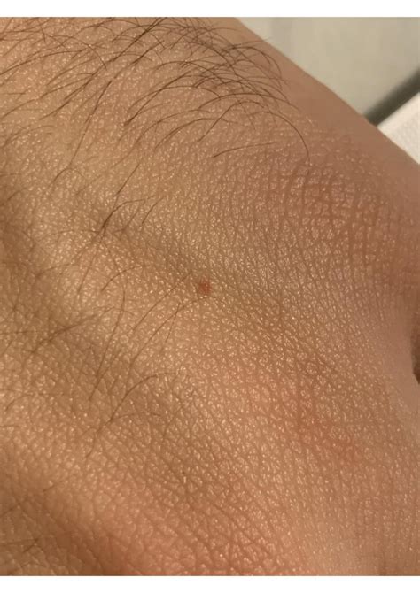 prurito diffuso, ipersensibilità cutanea e qualche segno ...