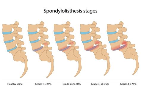 Certain lifestyle changes can help to. Facet Joint Injuries - My Family Physio