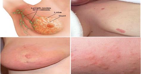 This breast cancer ultrasound image shows changes related to breast cancer that are not seen as microcalcifications or a mass or lump. Breast Cancer — Steemit