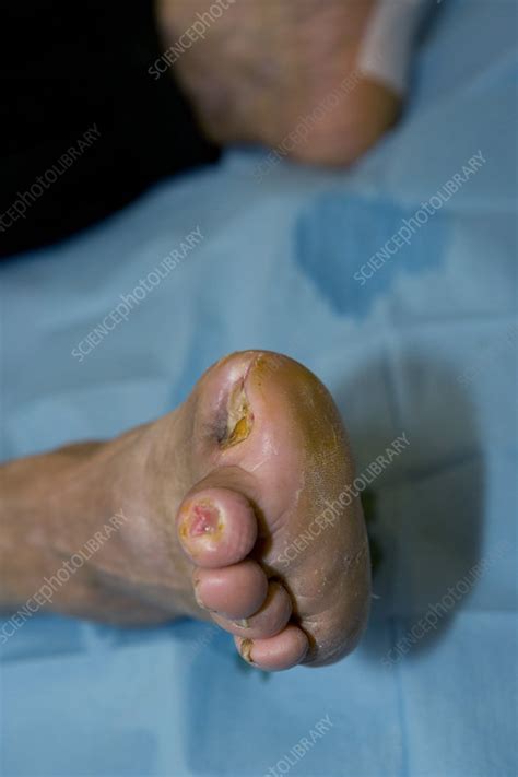 Möglicherweise unterliegen die inhalte jeweils zusätzlichen bedingungen. Diabetic foot - Stock Image - C002/0517 - Science Photo ...