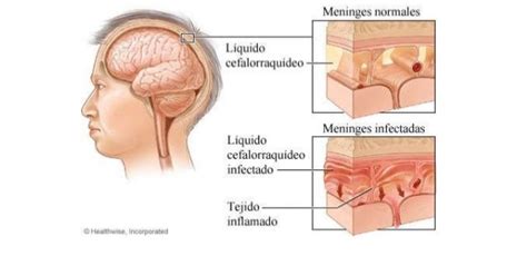 Oral versus aerosolized ribavirin for the treatment of respiratory syncytial virus infections in hematopoietic cell. ¡SER MAMÁ A LOS 30 !: Signos externos de meningitis en ...